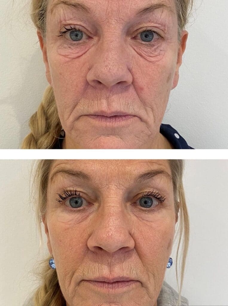NeoGen Plasma treatment for the appearance of fine lines and skin laxity around the eyes.