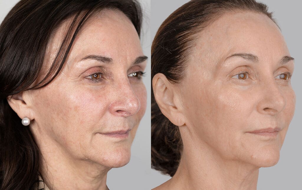 NeoGen Plasma facial skin rejuvenation treatment to improve skin texture, fine lines and firmness.